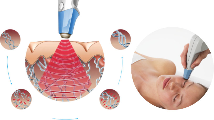 コラーゲン治療